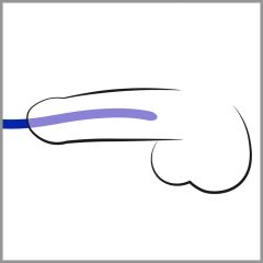   You2Toys - DILATOR - súprava modrých silikónových rozširovačov močovej trubice (3 ks)